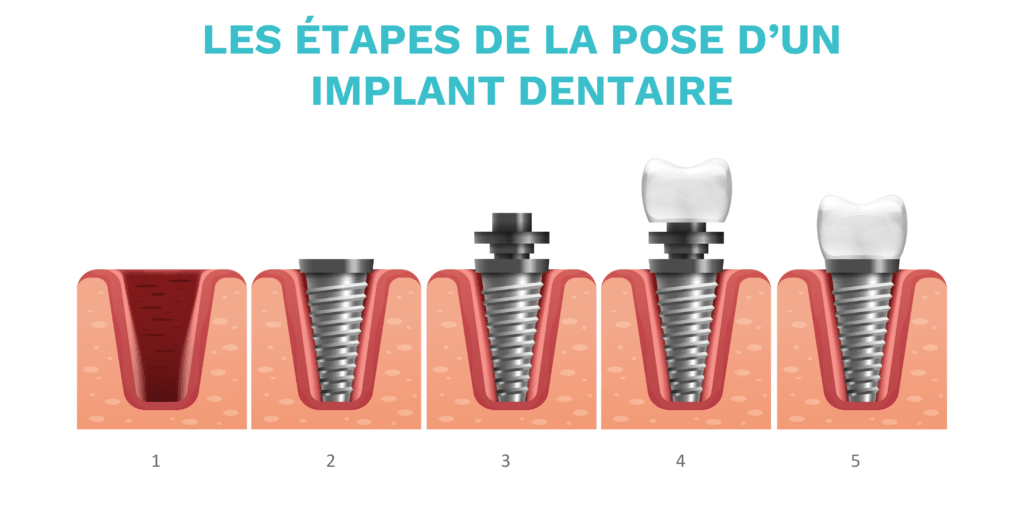 Pose d'un implant dentaire : étapes clés de la procédure